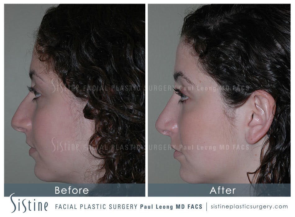 Nose Before and After | Leong Facial Plastic Surgery