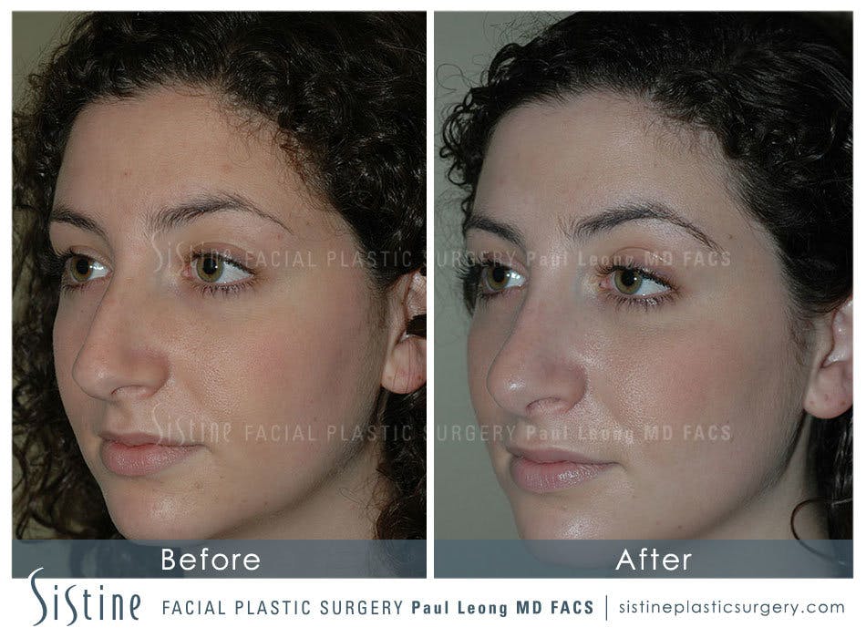 Nose Before and After | Leong Facial Plastic Surgery