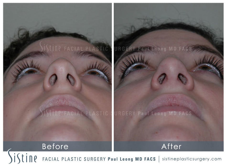 Nose Before and After | Leong Facial Plastic Surgery