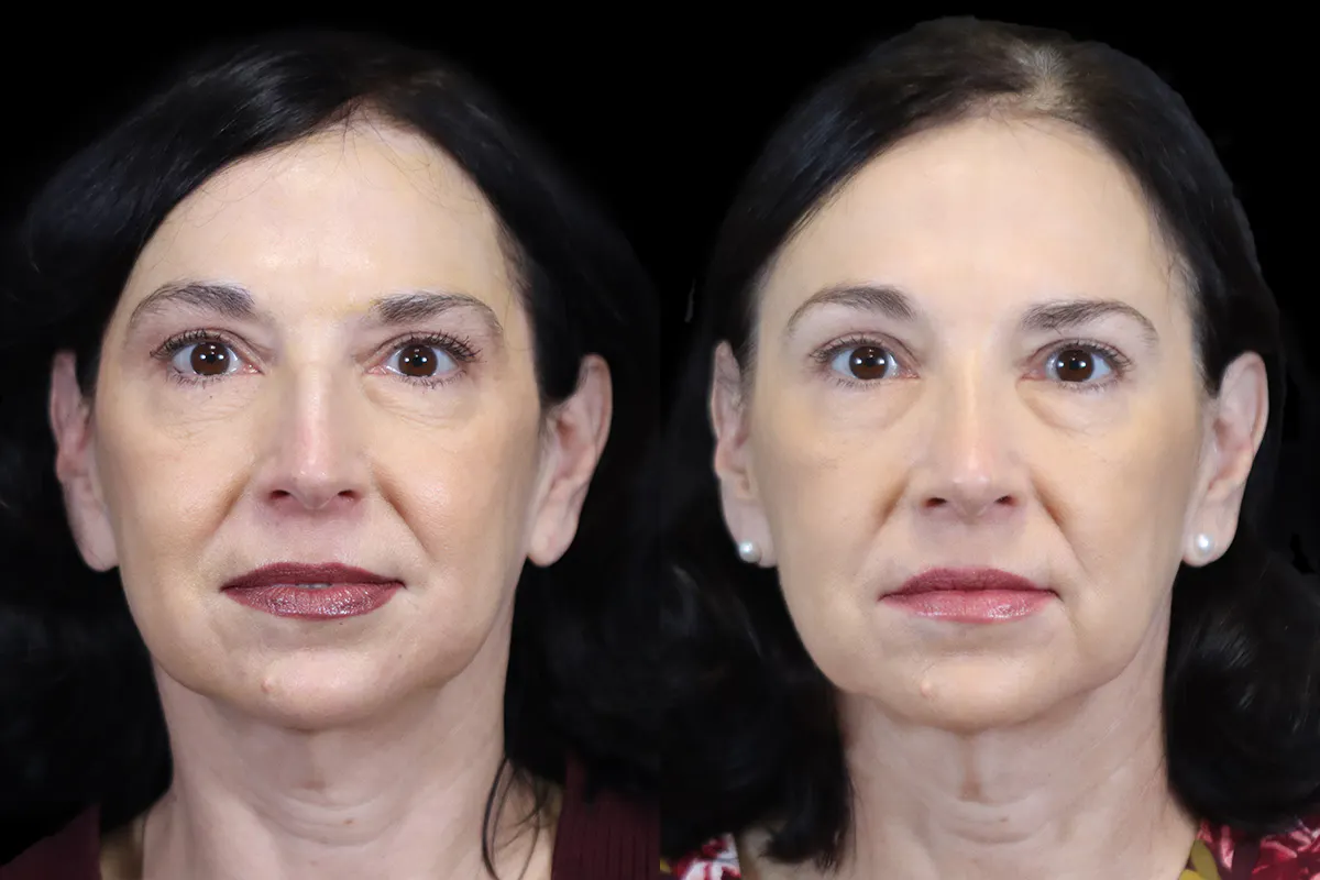 Nose Before and After | Leong Facial Plastic Surgery