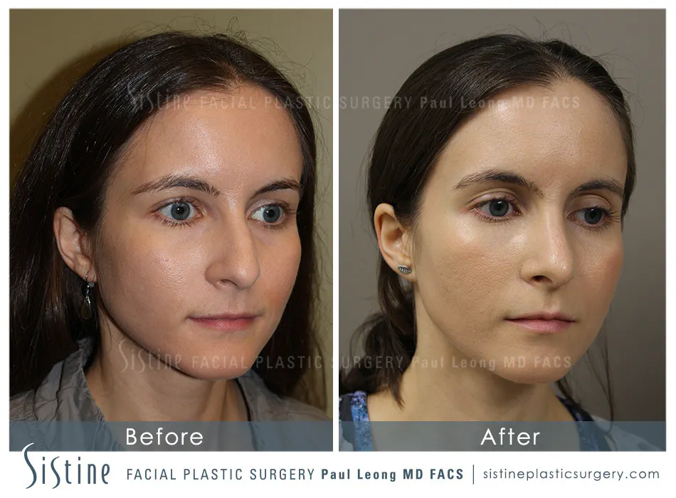 Nose Before and After | Leong Facial Plastic Surgery