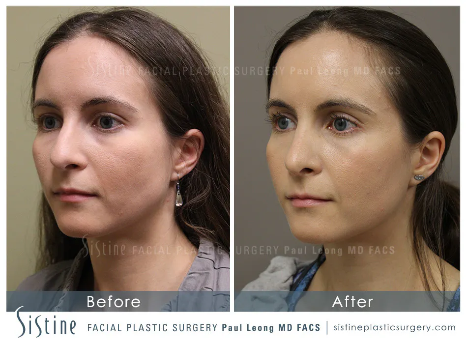Nose Before and After | Leong Facial Plastic Surgery