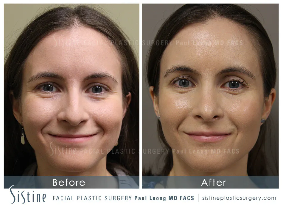 Nose Before and After | Leong Facial Plastic Surgery