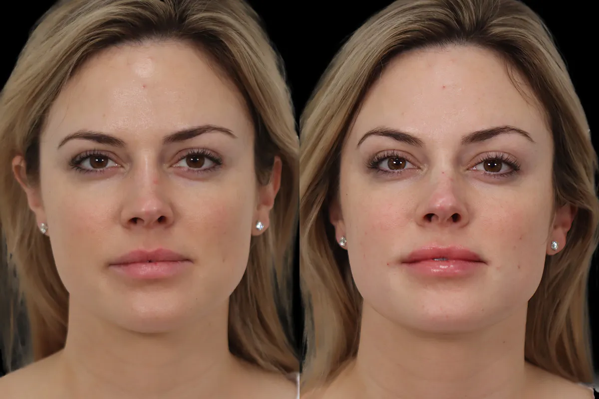 Nose Before and After | Leong Facial Plastic Surgery