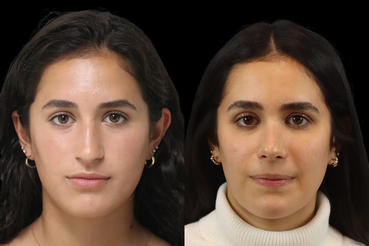 Nose Before and After | Leong Facial Plastic Surgery