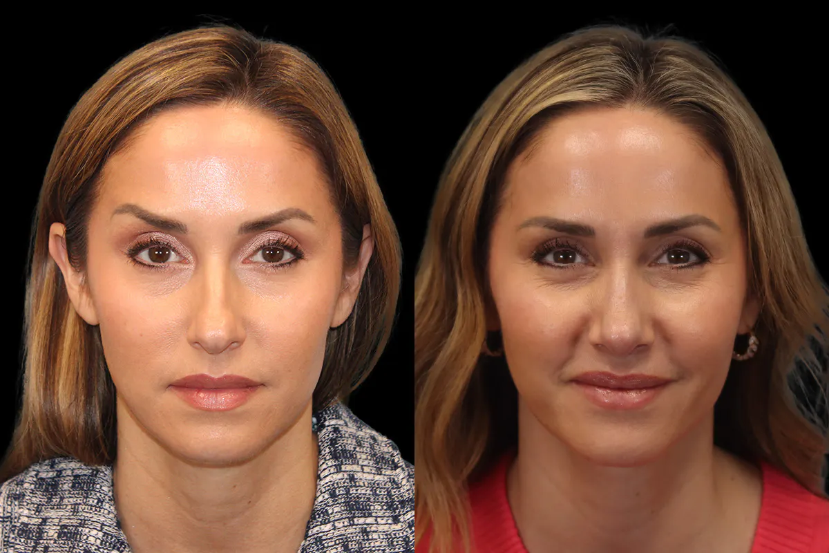 Nose Before and After | Leong Facial Plastic Surgery