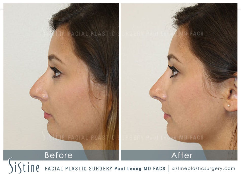 Nose Before and After | Leong Facial Plastic Surgery