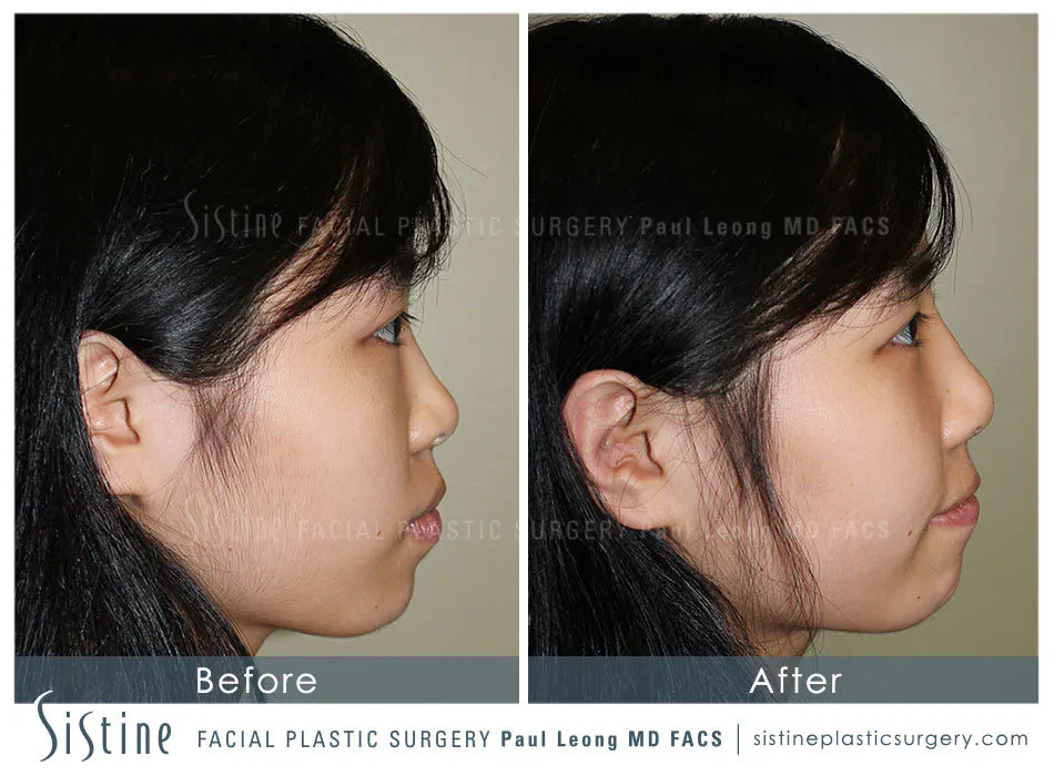 Nose Before and After | Leong Facial Plastic Surgery