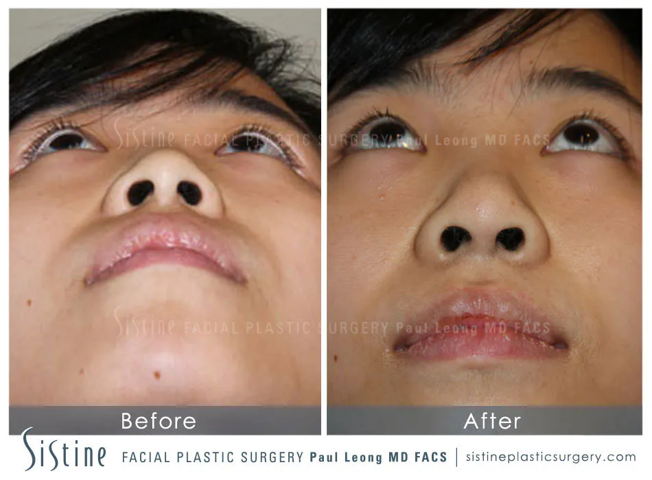 Nose Before and After | Leong Facial Plastic Surgery