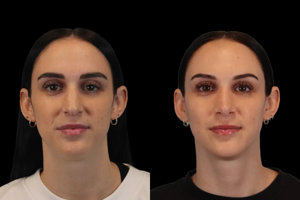 Nose Before and After | Leong Facial Plastic Surgery