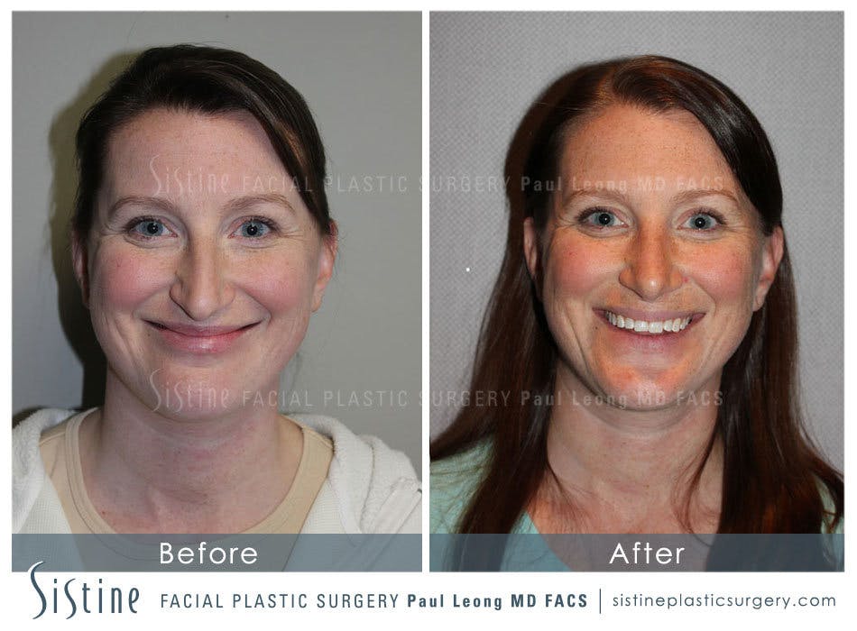 Nose Before and After | Leong Facial Plastic Surgery