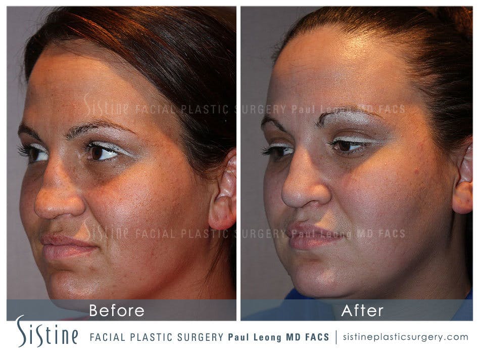 Nose Before and After | Leong Facial Plastic Surgery