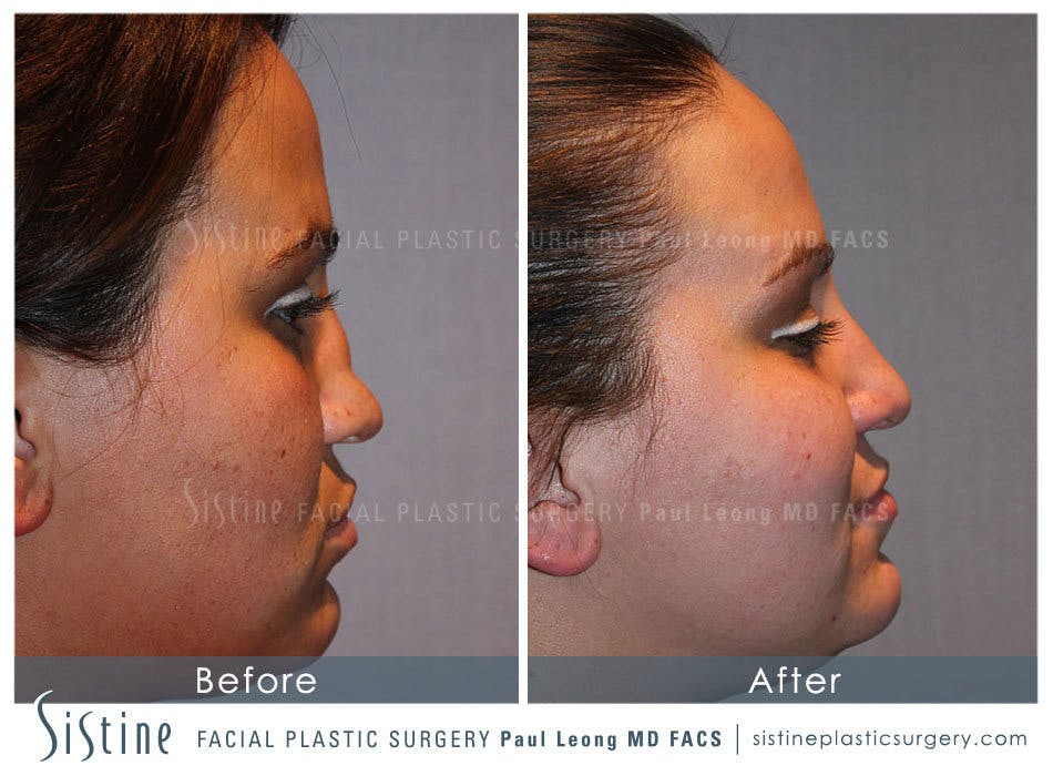 Nose Before and After | Leong Facial Plastic Surgery