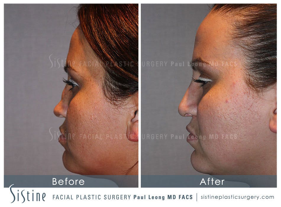 Nose Before and After | Leong Facial Plastic Surgery