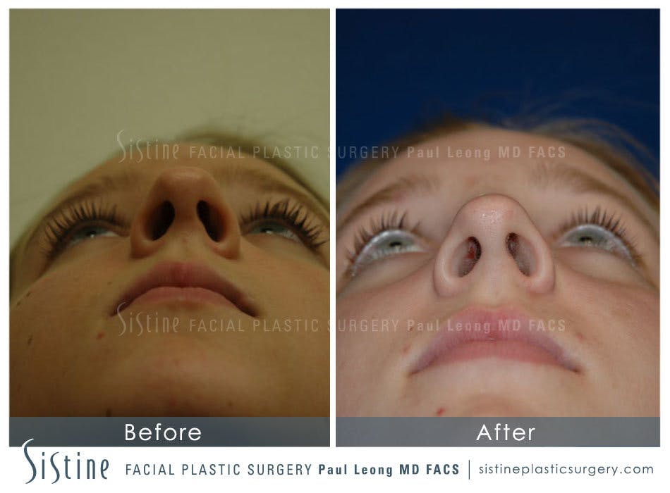 Nose Before and After | Leong Facial Plastic Surgery