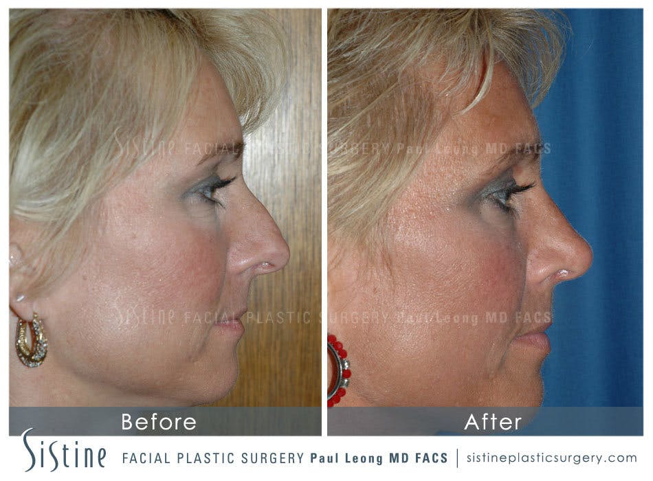 Nose Before and After | Leong Facial Plastic Surgery