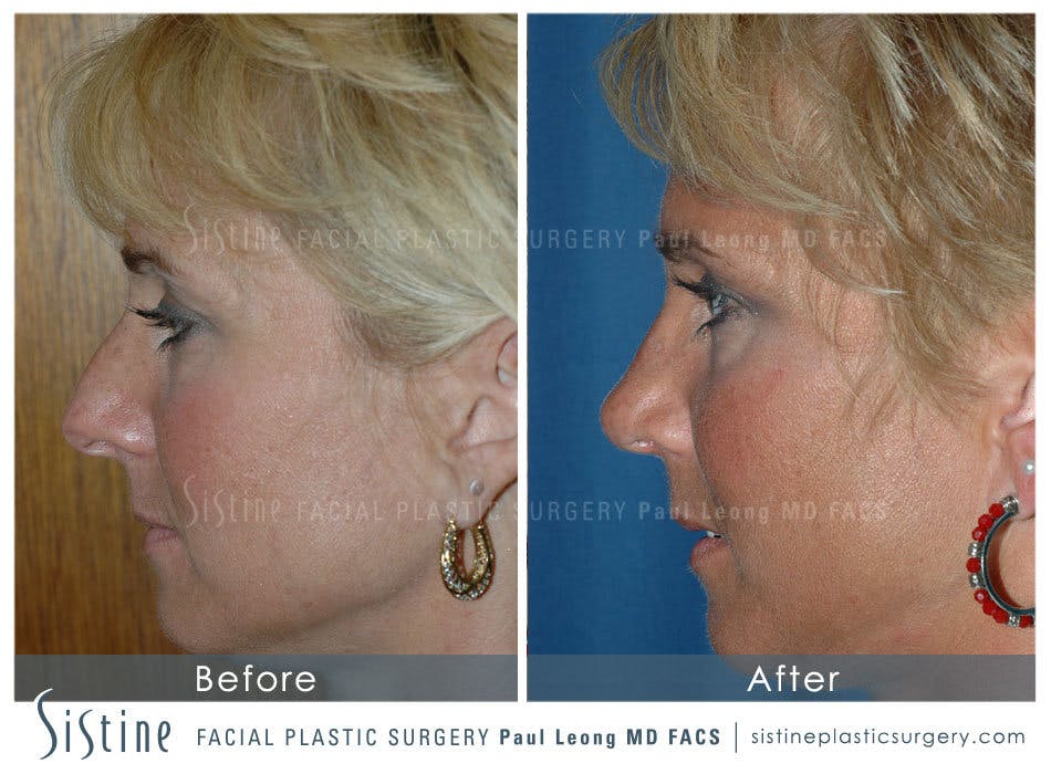 Nose Before and After | Leong Facial Plastic Surgery