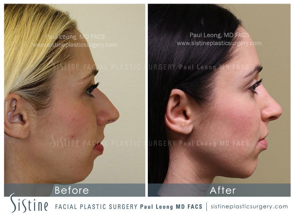 Nose Before and After | Leong Facial Plastic Surgery