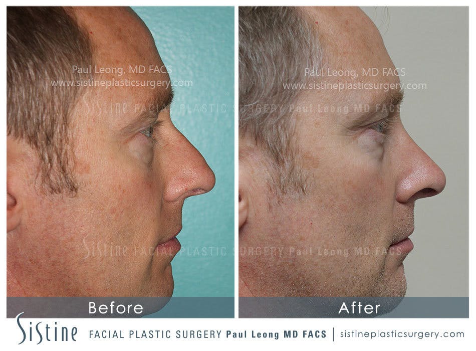 Nose Before and After | Leong Facial Plastic Surgery