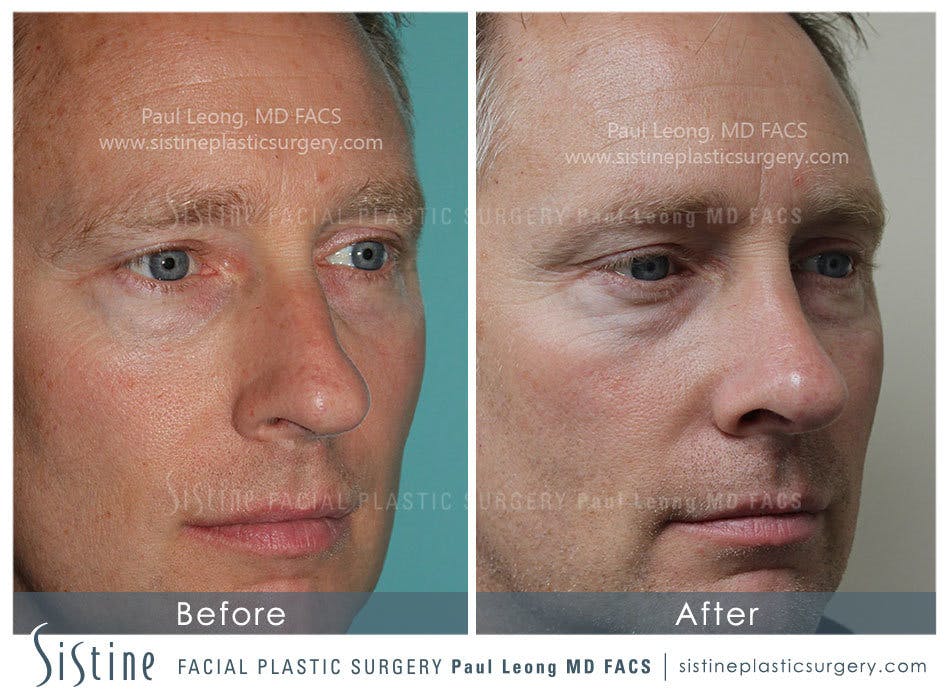 Nose Before and After | Leong Facial Plastic Surgery