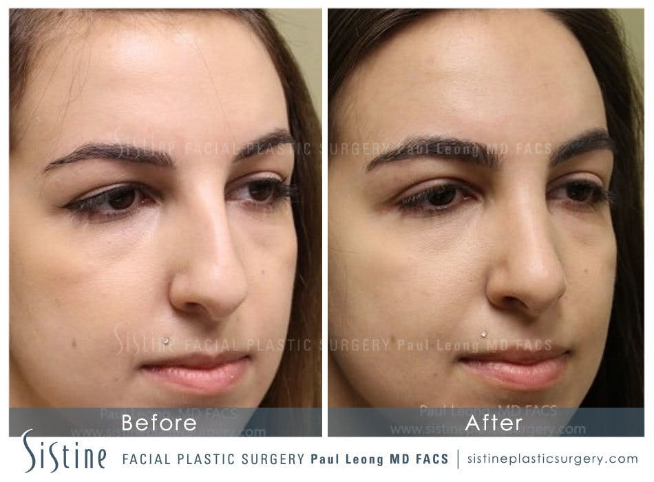 Nose Before and After | Leong Facial Plastic Surgery