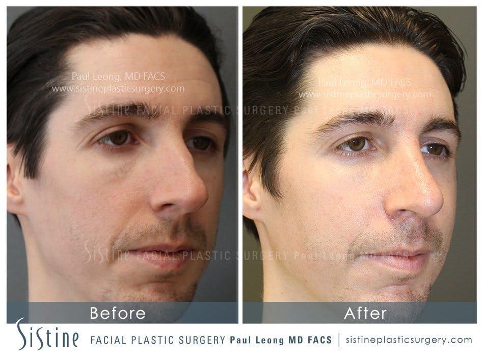 Nose Before and After | Leong Facial Plastic Surgery