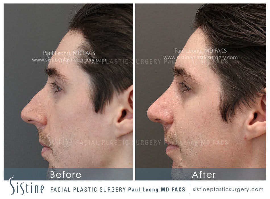Nose Before and After | Leong Facial Plastic Surgery