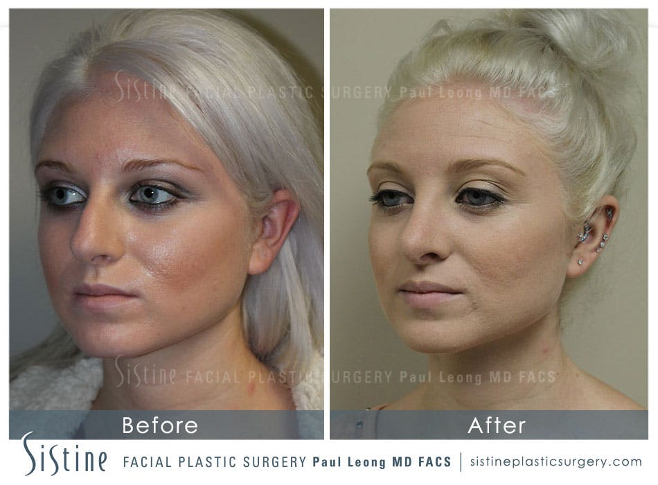 Nose Before and After | Leong Facial Plastic Surgery
